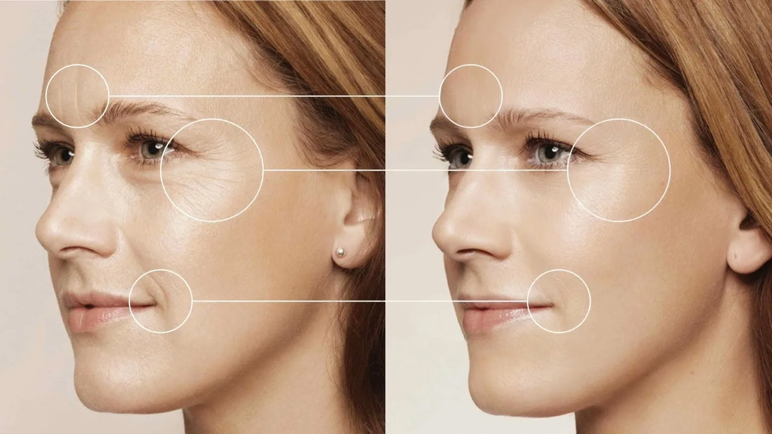 Căng da mặt giúp chị em giảm nhăn, trẻ hóa