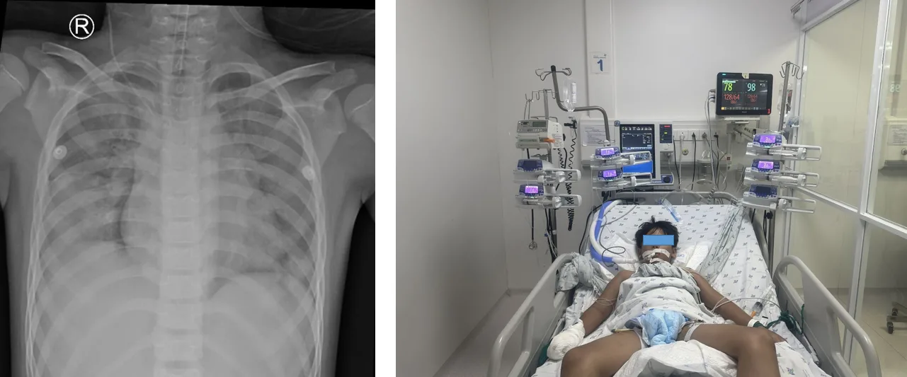 Xquang phổi cho thấy tổn thương phổi nặng lan tỏa 2 phế trường, dẫn đến trao đổi oxy kém, gây thiếu oxy máu nặng