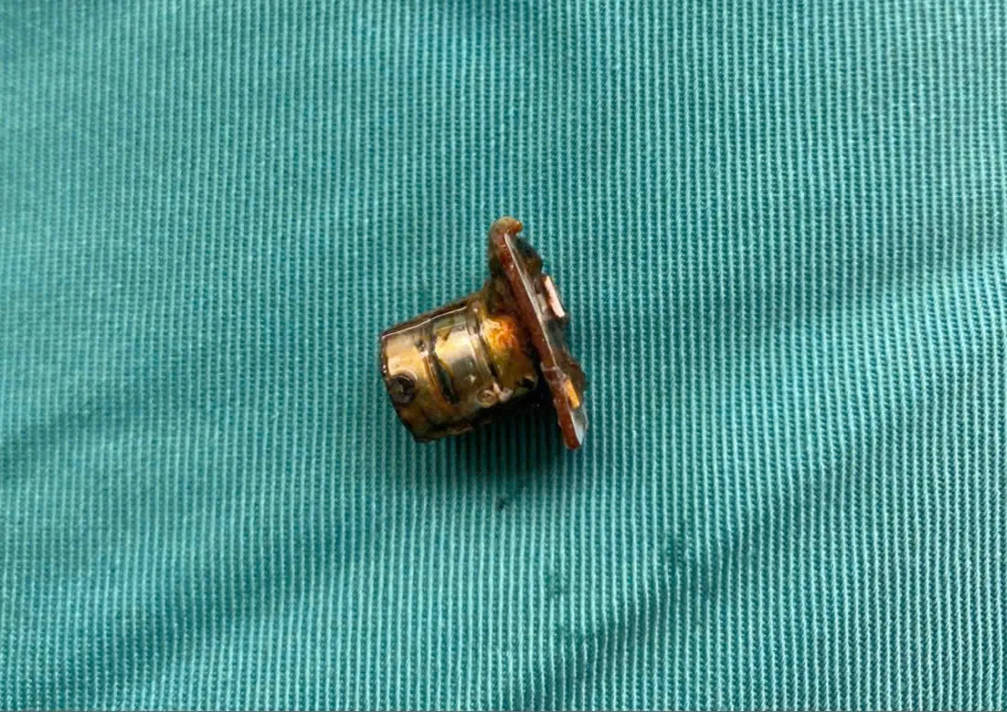 Pin cúc áo được các bác sĩ lấy ra