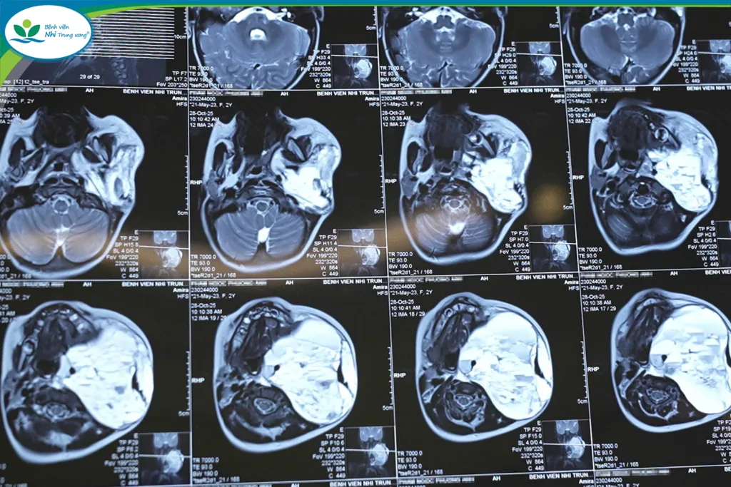 Ngay cả khi trẻ đã rơi vào tình trạng suy hô hấp, phải thở máy thì khối u vẫn tiếp tục phát triển, đe dọa tính mạng bệnh nhi