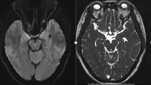 Hình ảnh kết quả chụp cộng hưởng từ của người bệnh