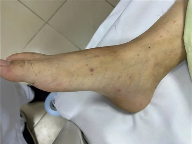 Ban xuất huyết trên cơ thể người bệnh