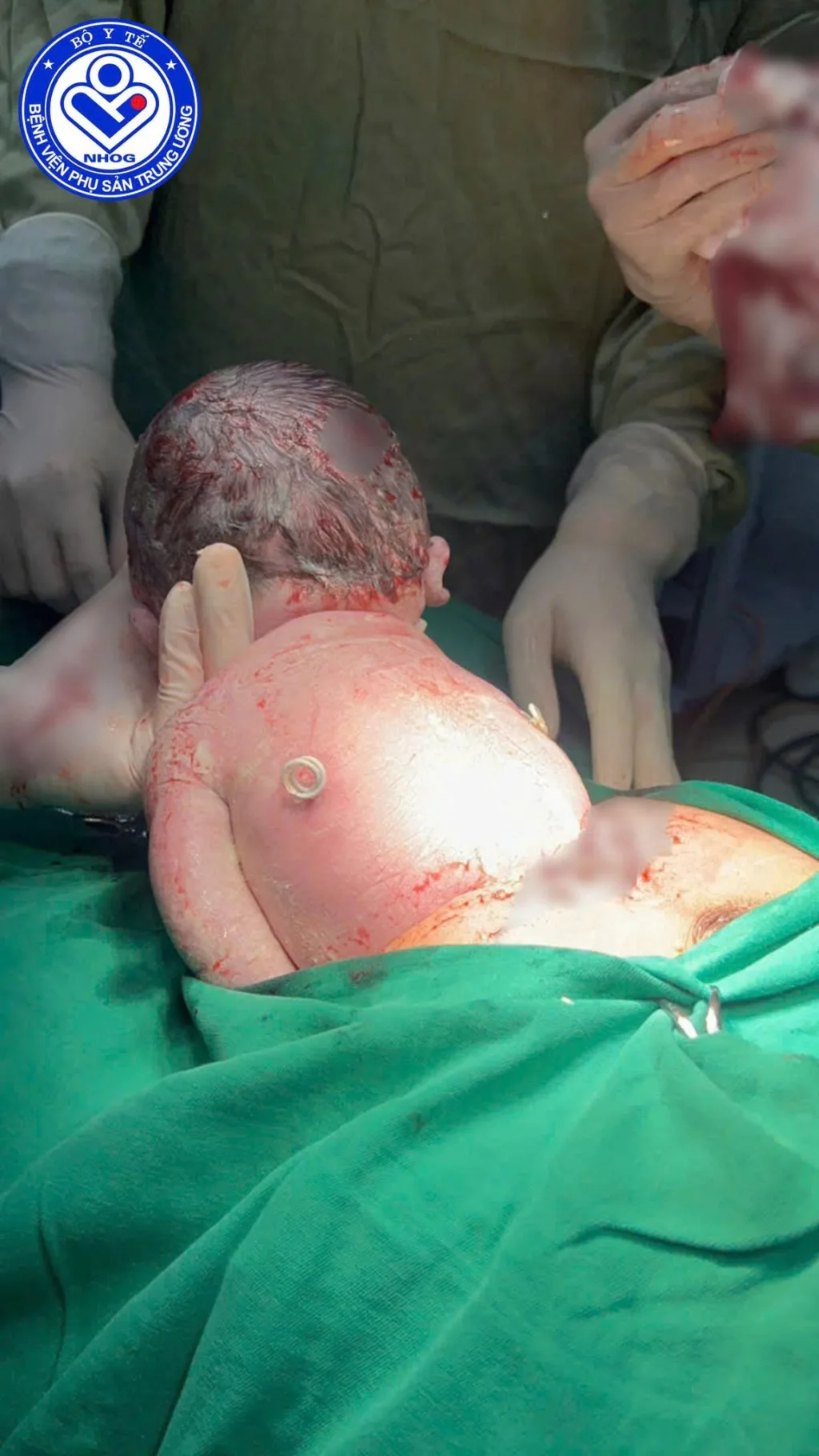 Trên lưng em, hai ống shunt nhỏ vẫn còn đó - như “đôi cánh tí hon” vừa hoàn thành sứ mệnh của mình