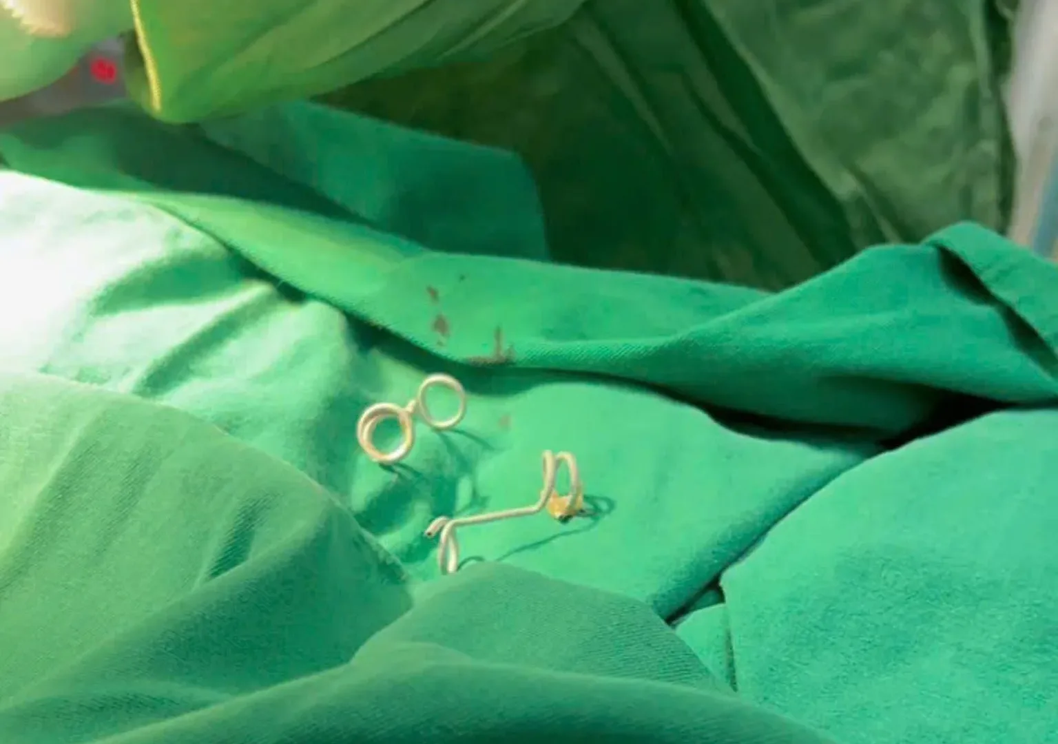 2 ống dẫn lưu được rút ngay khi e bé được lấy ra khỏi tử cung