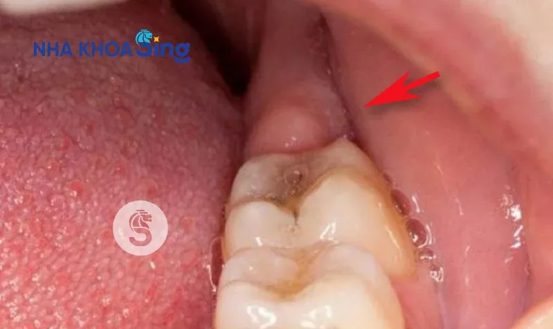 Nướu (lợi) bị sưng tấy khi mọc răng khôn